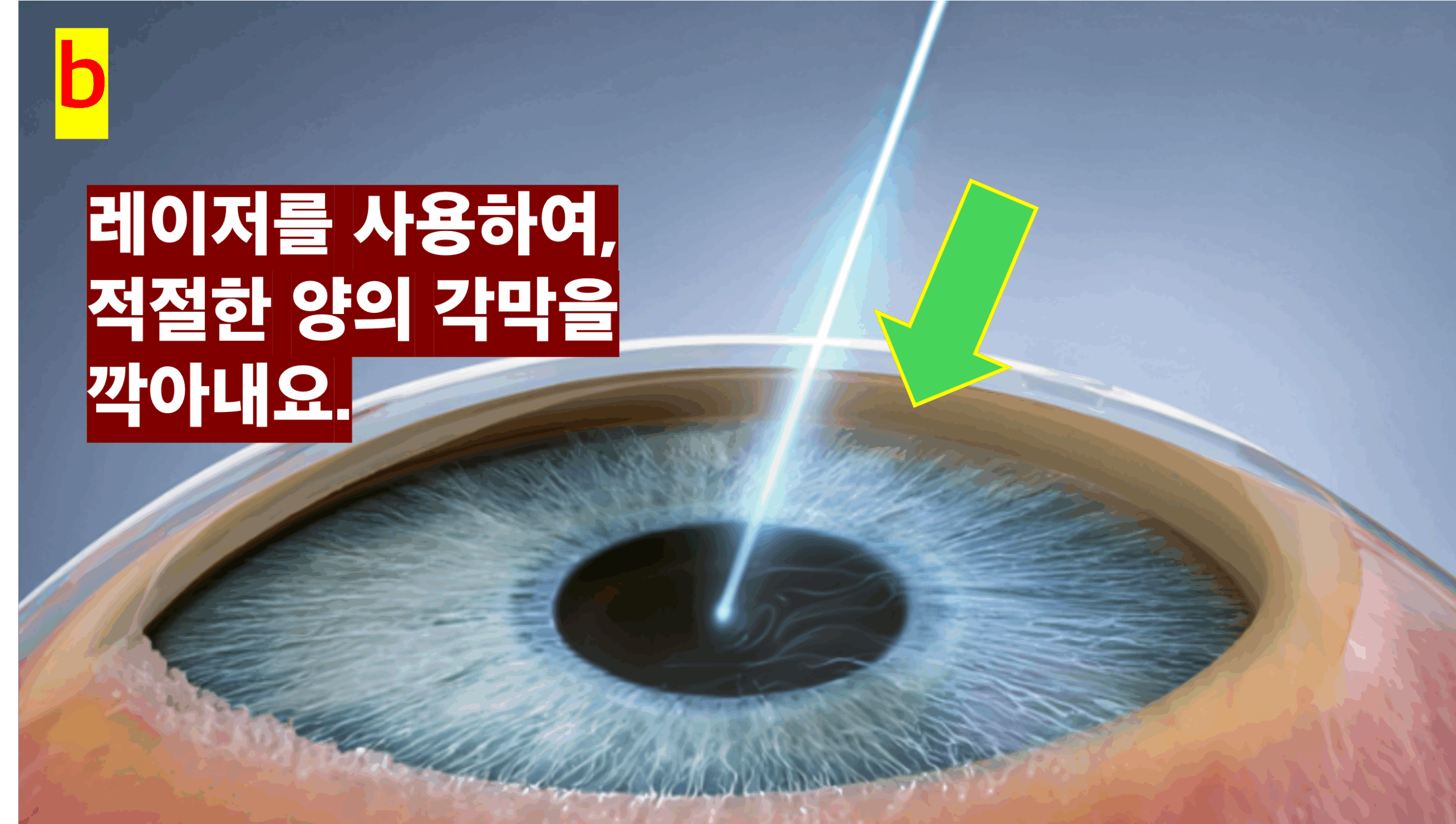 라식 수술 과정 중 레이저 조사 장면