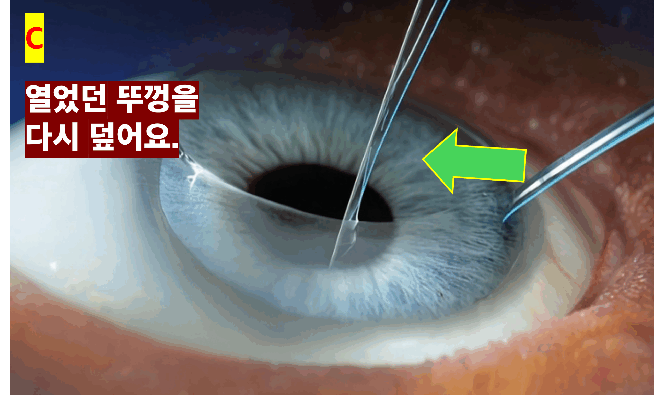 라식 수술 과정 중 각막 뚜껑(절편)을 덮는 모습