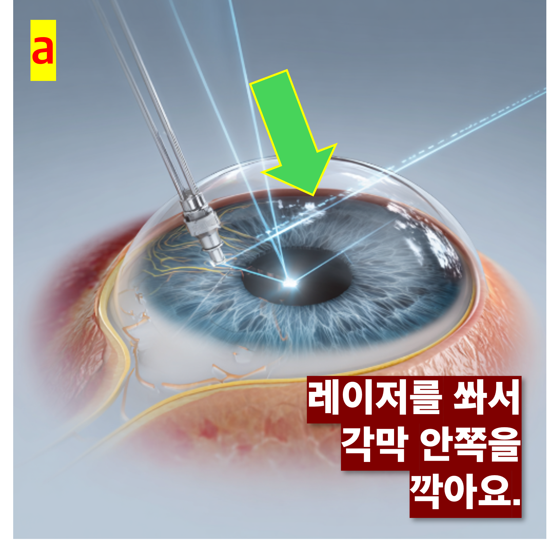 스마일라식 수술 과정 중 레이저 조사