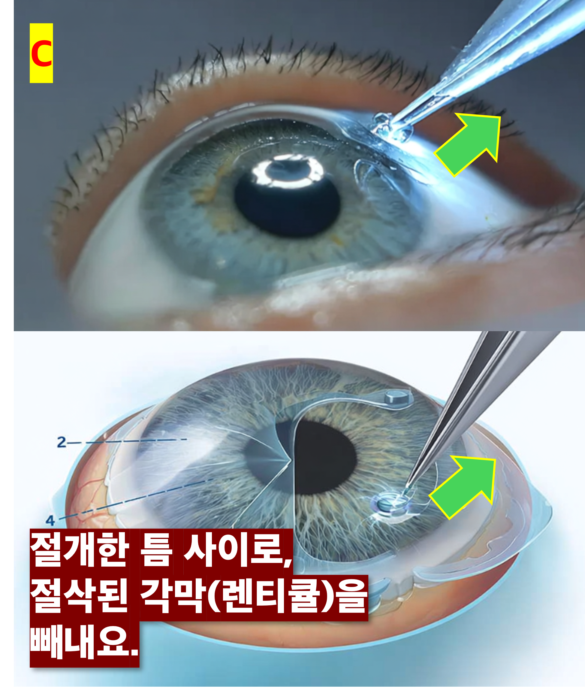 스마일라식 수술 중 각막 렌티큘 빼내는 장면